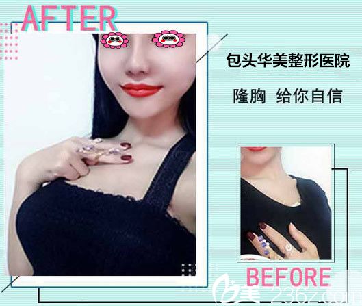 华美王金红隆胸效果图 华美王金红隆胸效果图