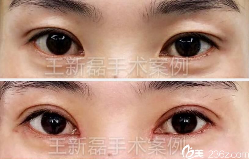 王新磊失败双眼皮修复案例前后效果对比