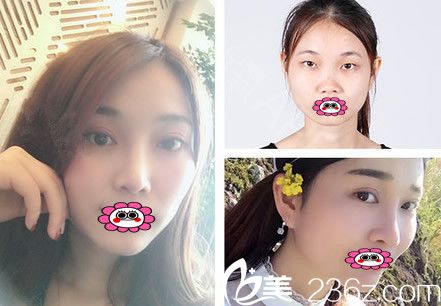 嘉兴曙光双眼皮前后对比案例 嘉兴曙光双眼皮前后对比案例