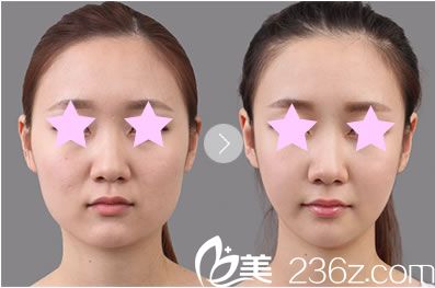 桂林华美整形线雕V脸提升前后对比图