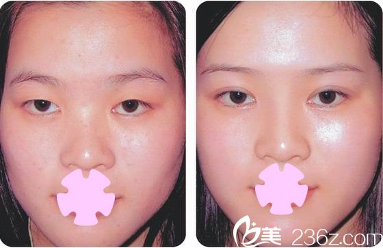 桂林华美双眼皮案例效果图