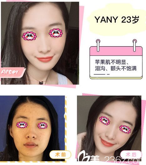 嘉兴曙光整形白云亮主任面部脂肪填充效果图 嘉兴曙光整形白云亮主任面部脂肪填充效果图