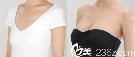 华美连锁整形隆胸前后对比照片