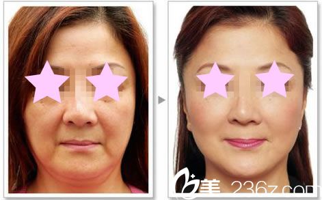 华美整形全脸线雕提升效果