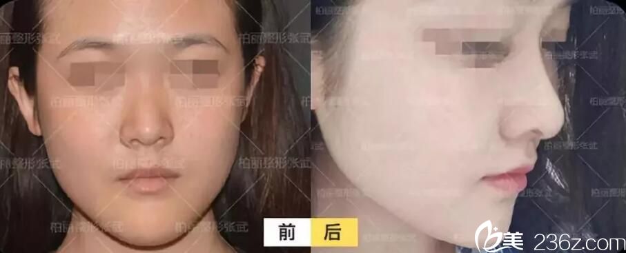 张武主任曾做过的鼻综合整形案例 张武主任曾做过的鼻综合整形案例