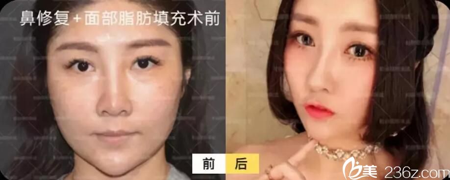 张武隆鼻失败修复+自体脂肪全脸填充案例前后效果对比图 张武隆鼻失败修复+自体脂肪全脸填充案例前后效果对比图