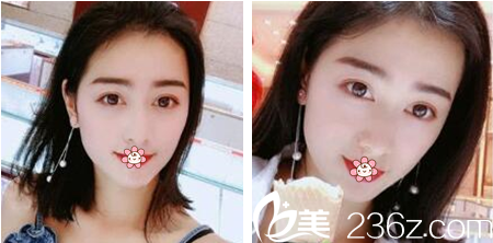 韩国夏娃eve整形外科做双眼皮怎么样