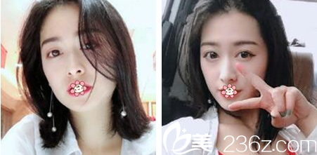 郑润载双眼皮术后2个月