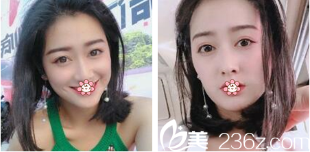 韩国夏娃eve整形郑润载做双眼皮效果怎么样