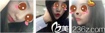 上海美莱医疗美容医院申涛玻尿酸隆鼻真人案例术后二十天