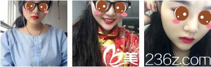 上海美莱医疗美容医院申涛玻尿酸隆鼻真人案例术后一个月