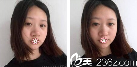 手术前的我 手术前的我