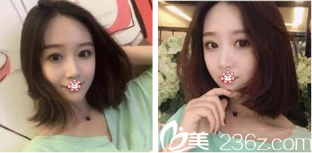 泰国然禧Yanhee整形医院做双眼皮怎么样 泰国然禧Yanhee整形医院做双眼皮怎么样