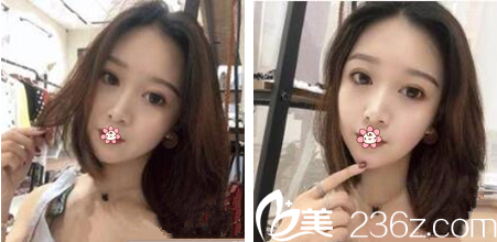 泰国然禧Yanhee整形隆鼻技术好不好 泰国然禧Yanhee整形隆鼻技术好不好