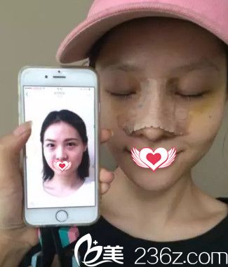 卢闯医生为我刚做完鼻综合术后拥有高挺鼻