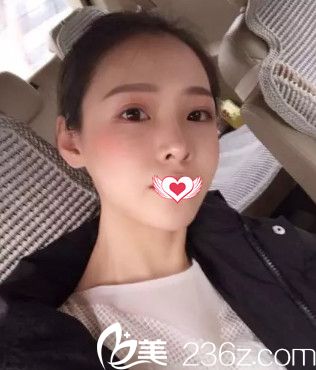 蓝山整形医生卢闯做鼻综合术后18天完全消肿