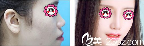 深圳富华鼻综合手术真人案例效果 深圳富华鼻综合手术真人案例效果