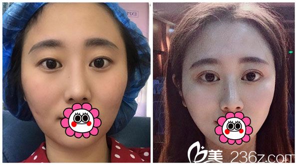 肖育亮眼综合+全切双眼皮效果对比图 肖育亮眼综合+全切双眼皮效果对比图