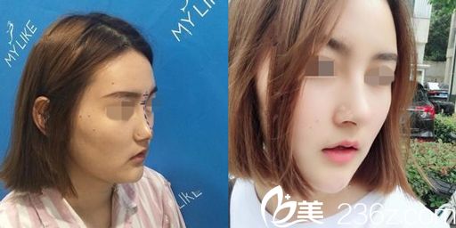 白玉龙主任做假体隆鼻术前术后对比图 白玉龙主任做假体隆鼻术前术后对比图