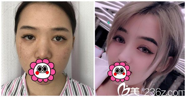 王德宁假体隆鼻+激光祛斑效果案例 王德宁假体隆鼻+激光祛斑效果案例