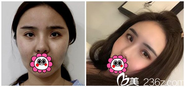 胡乔自体脂肪全脸填充效果对比图 胡乔自体脂肪全脸填充效果对比图