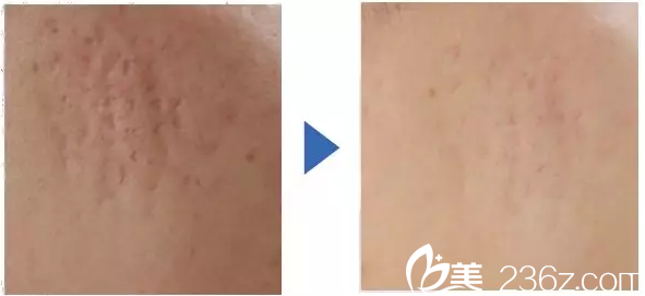 祛除痘印的效果 祛除痘印的效果