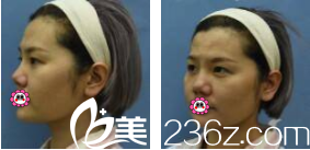 在北京雅靓做眼综合前样子 在北京雅靓做眼综合前样子