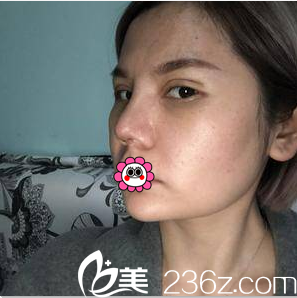 陈林叶给我做眼综合第10天效果 陈林叶给我做眼综合第10天效果