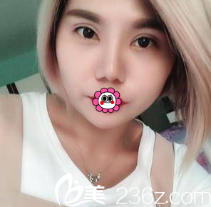 北京雅靓眼综合案例 北京雅靓眼综合案例