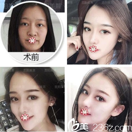 贵阳美莱整形隆鼻好不好？