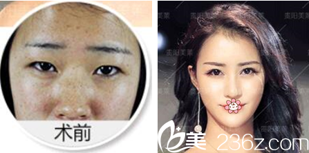 贵阳美莱祛斑案例