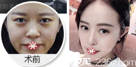 贵阳美莱线雕技术怎么样？