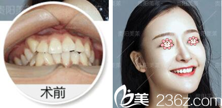 贵阳美莱整形牙齿正畸案例