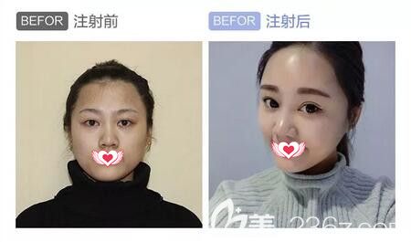 注射瑞蓝2号玻尿酸填充太阳穴、苹果肌真人前后对比 注射瑞蓝2号玻尿酸填充太阳穴、苹果肌真人前后对比