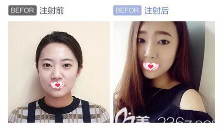 注射瑞蓝2号玻尿酸填充下巴、鼻子、泪沟真人前后效果对比 注射瑞蓝2号玻尿酸填充下巴、鼻子、泪沟真人前后效果对比