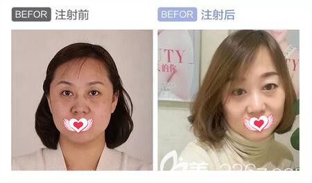 注射瑞蓝2号玻尿酸填充面部及除皱真人前后效果对比 注射瑞蓝2号玻尿酸填充面部及除皱真人前后效果对比