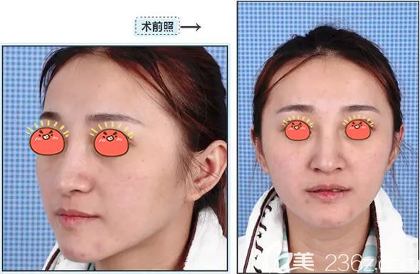 在义乌阳光医院做脂肪填充前 在义乌阳光医院做脂肪填充前