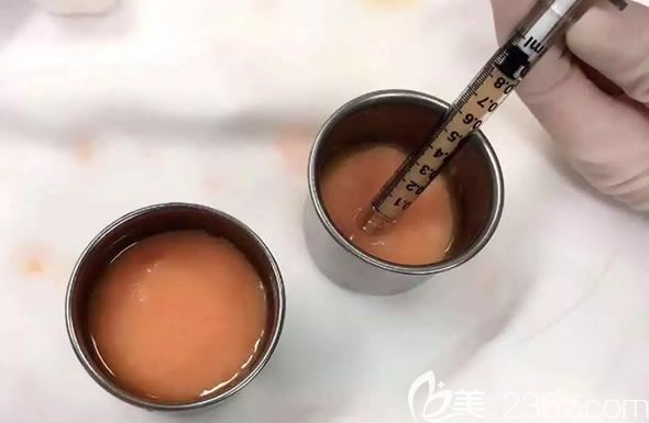 从腰腹部抽取的脂肪细胞 从腰腹部抽取的脂肪细胞