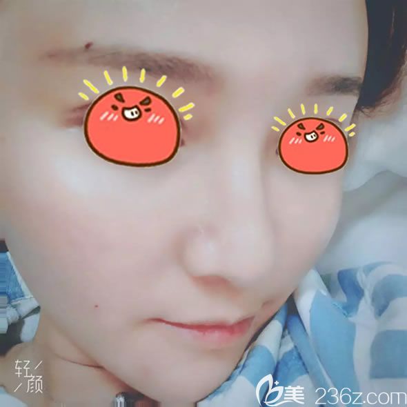 刚做完自体脂肪填充的照片 刚做完自体脂肪填充的照片