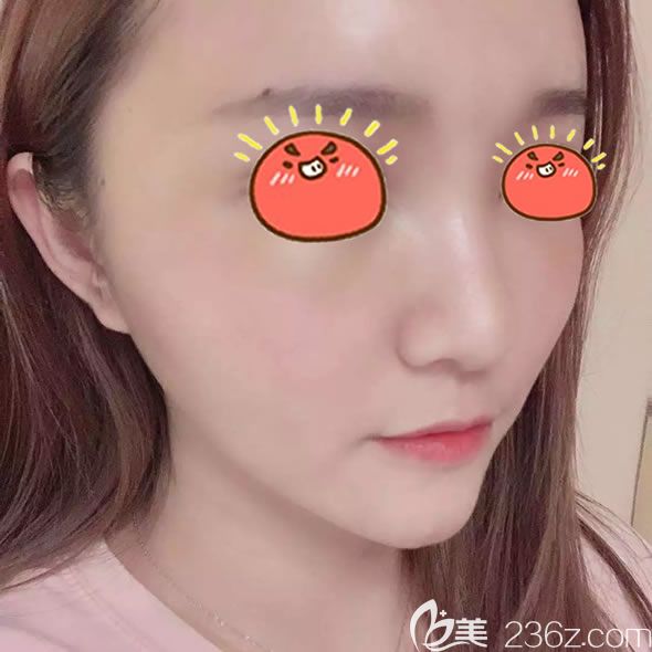 做完自体脂肪填充全脸7天恢复照 做完自体脂肪填充全脸7天恢复照