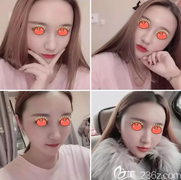 自体脂肪填充半个月<span style= 自体脂肪填充半个月<span style=