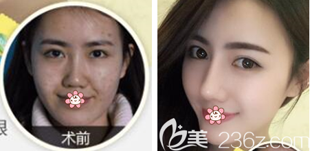 贵阳华美做双眼皮隆鼻效果怎么样 贵阳华美做双眼皮隆鼻效果怎么样