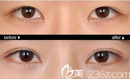 郭建医生做韩式无痕双眼皮术后效果对比 郭建医生做韩式无痕双眼皮术后效果对比