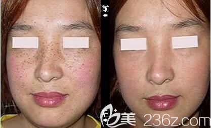 武强医生做皮秒祛斑术前术后案例对比 武强医生做皮秒祛斑术前术后案例对比