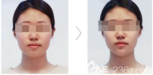 田雨注射瘦脸除皱案例 田雨注射瘦脸除皱案例