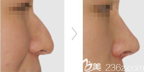 田雨鼻尖形成术案例 田雨鼻尖形成术案例
