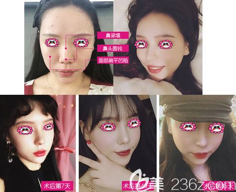 呼和浩特大韩整形鼻综合效果图 呼和浩特大韩整形鼻综合效果图