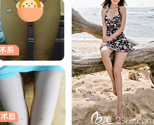 呼和浩特大韩整形医院大腿吸脂对比图 呼和浩特大韩整形医院大腿吸脂对比图