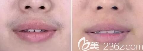 永州博美脱唇毛真人<span style= 永州博美脱唇毛真人<span style=