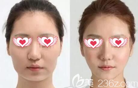 玻尿酸填充面部真人<span style= 玻尿酸填充面部真人<span style=